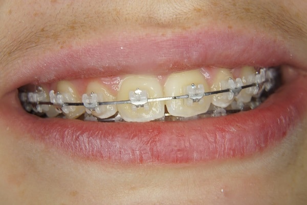 Bagues dentaires en céramique → Orthodontiste à Lyon 3 - Dr Pagliano Fabienne
