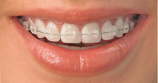 orthodontiste lyon 3 invisible